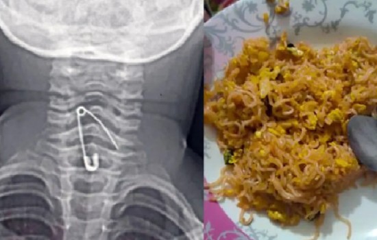 নুডলস খাওয়ার সময় শিশুর গলায় আটকে গেল সেফটি পিন