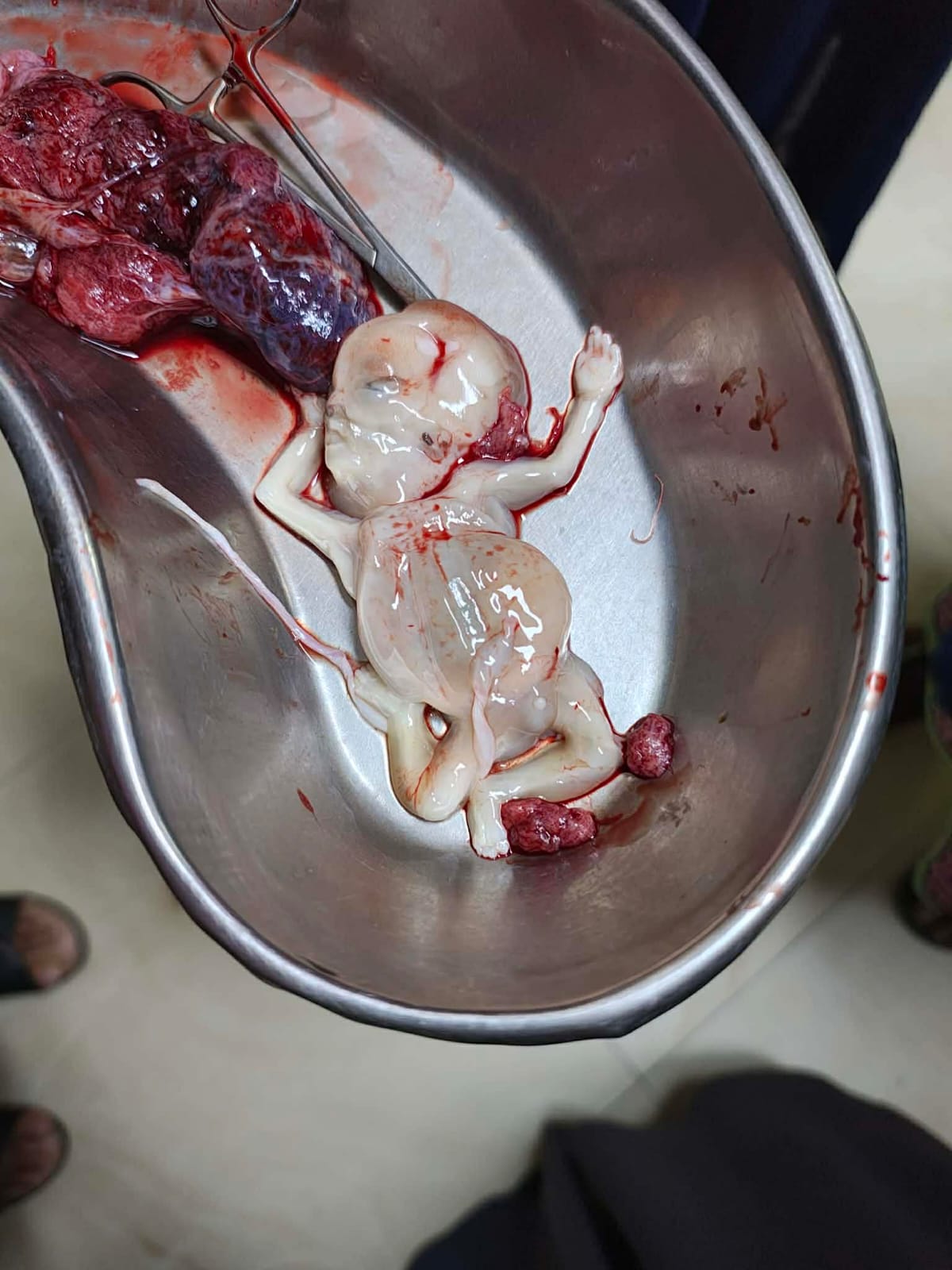 রূপগঞ্জে পেটে লাথি মেরে গর্ভের সন্তান হত্যার অভিযোগ